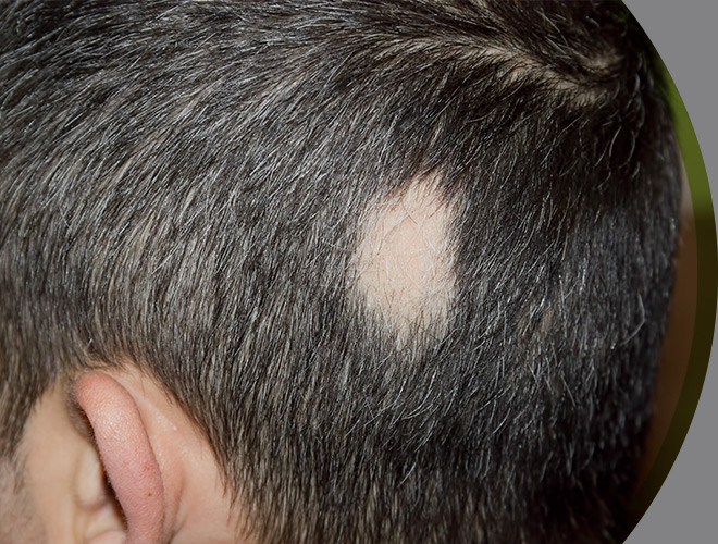 dermatologia-clinica-alopecia-interna